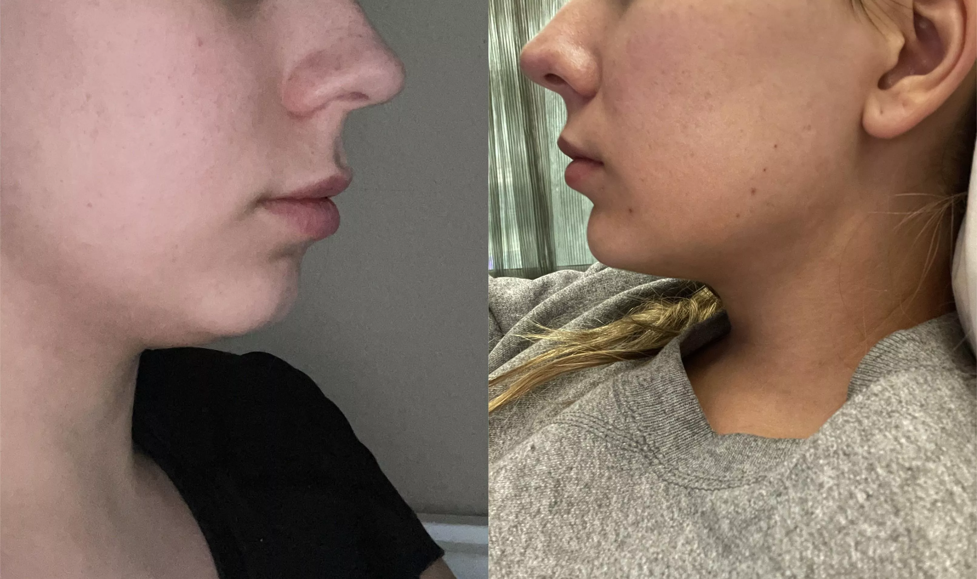 I know that people really love lip filler here, but I decided to show off my chin filler before/after too in case any bimbos are curious!