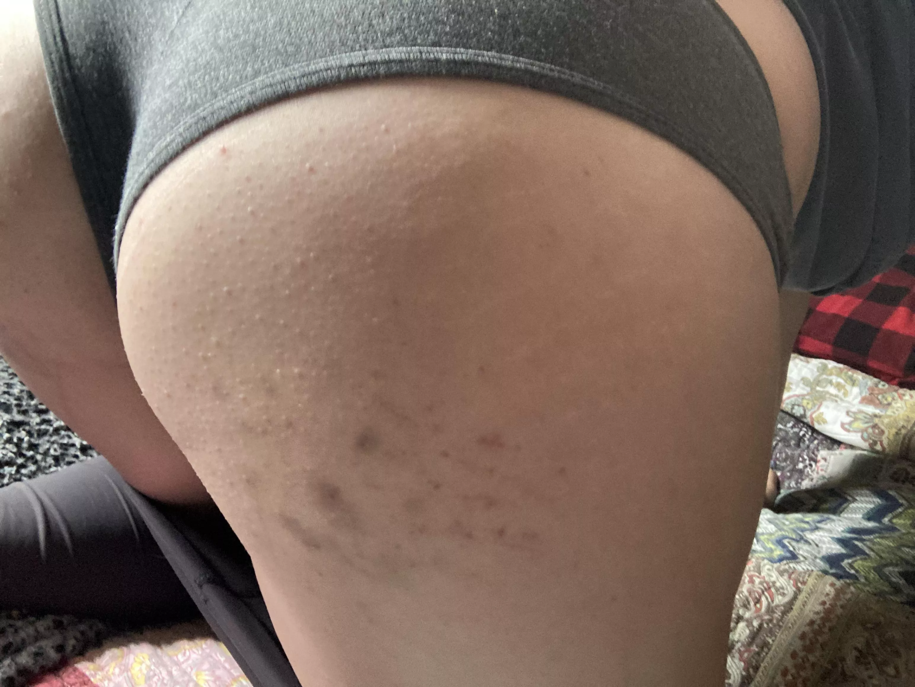 Light bruising from my first spanking session