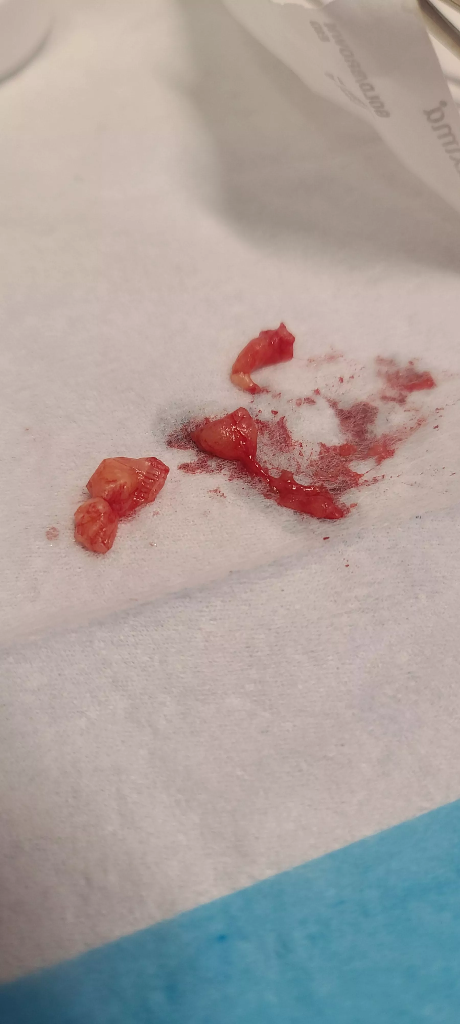 Lipoma removed from groin