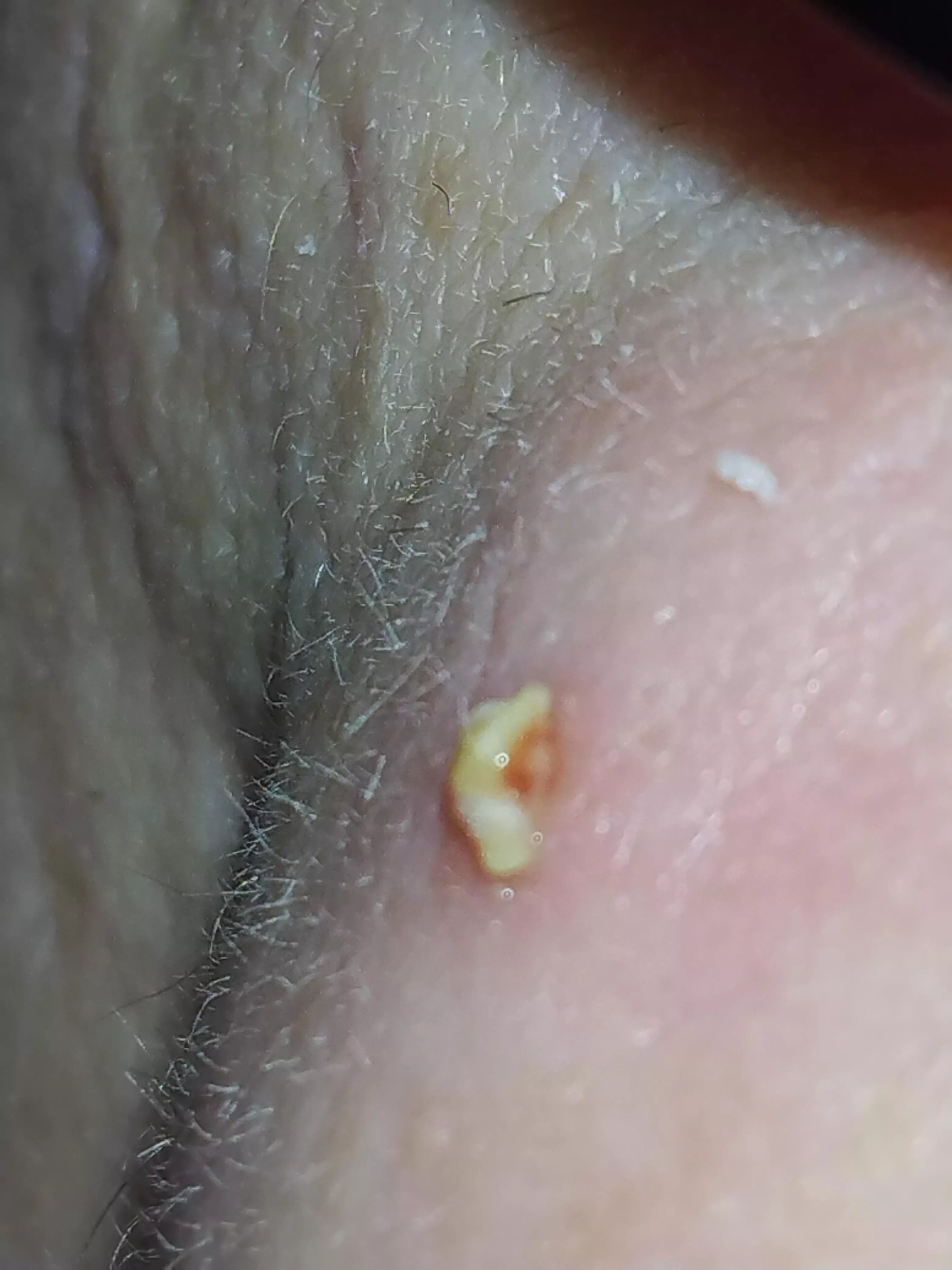 Massive zit on my cheek. I'm not talented enough to film; I needed both hands for the pop.