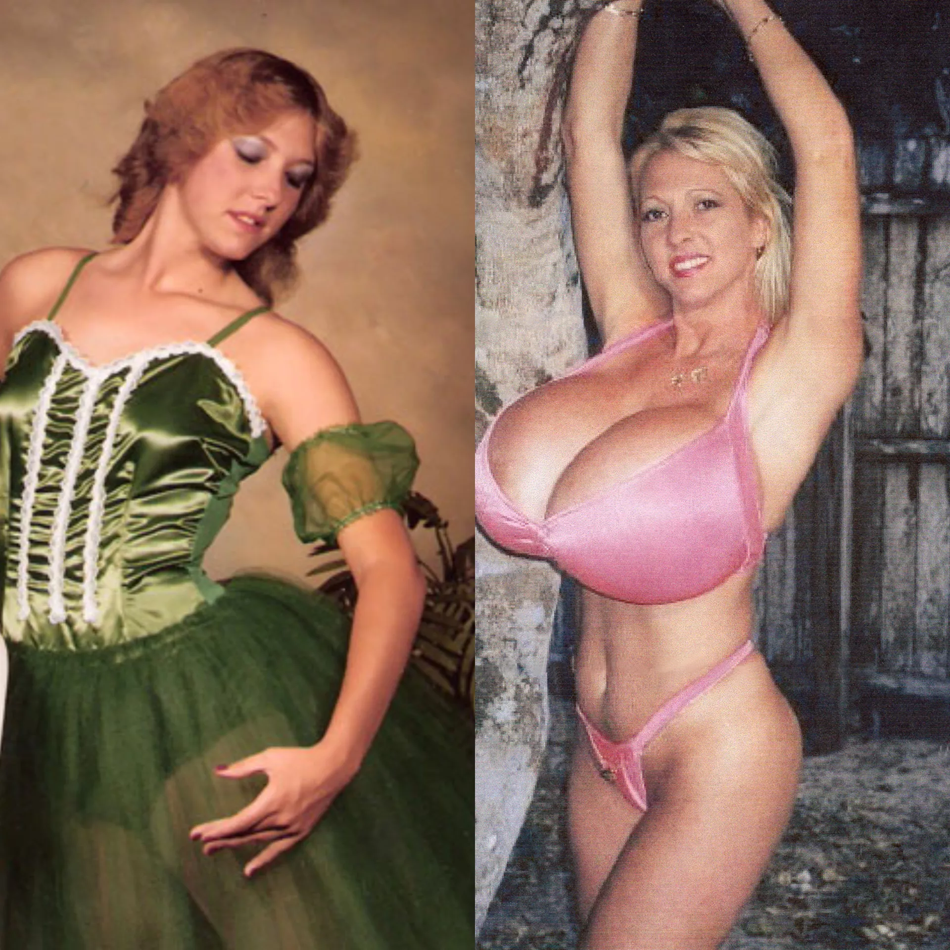 Maxi Mounds before and after. Guinness world record for biggest implants