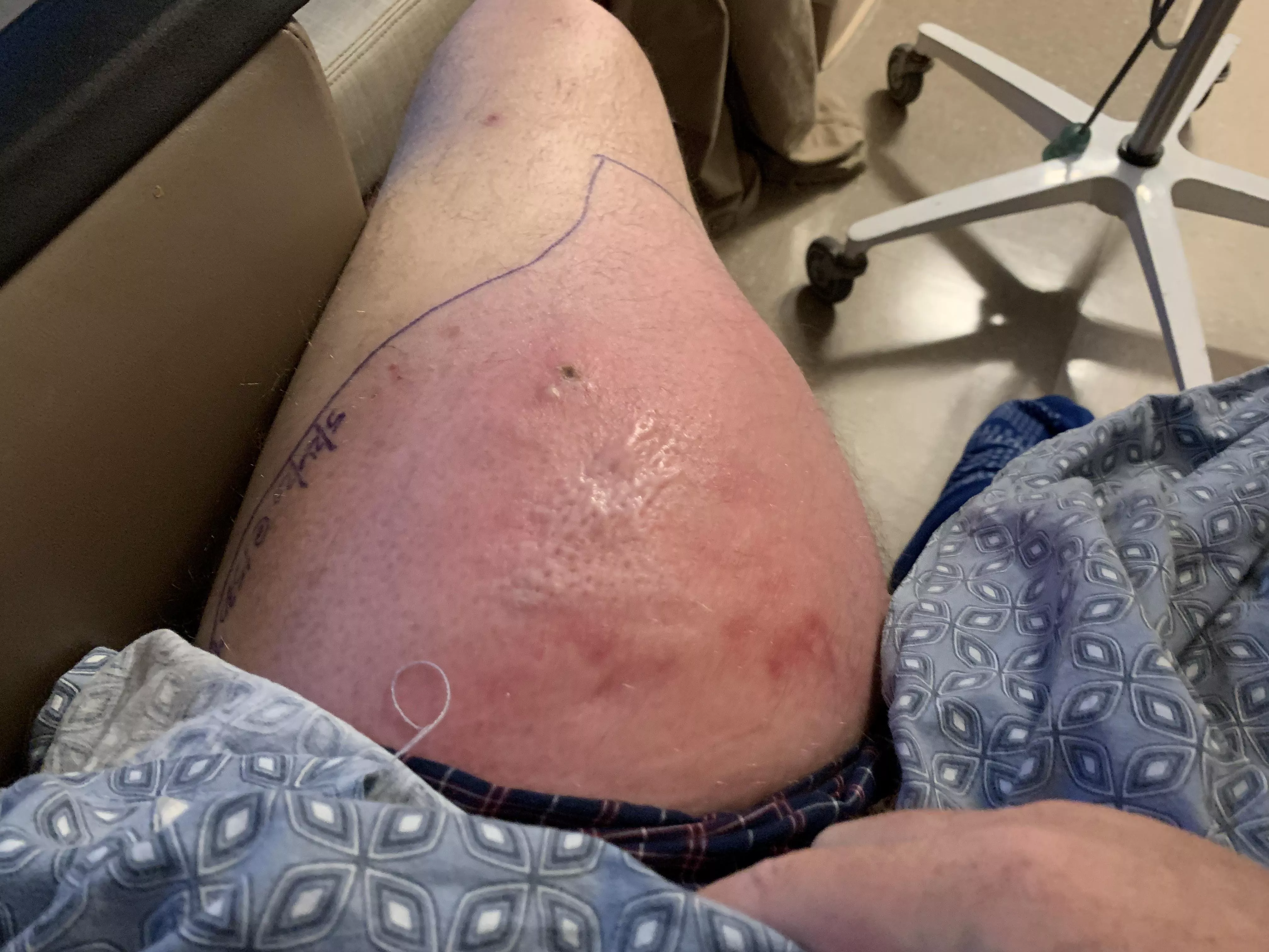 MRSA, spent a week in the hospital on IV antibiotics for this infection. If I stood it would drain on its own. Gave him a squeeze and a long black string came out. Surgeon, told me it was a vein. Had to pack it for two weeks after.