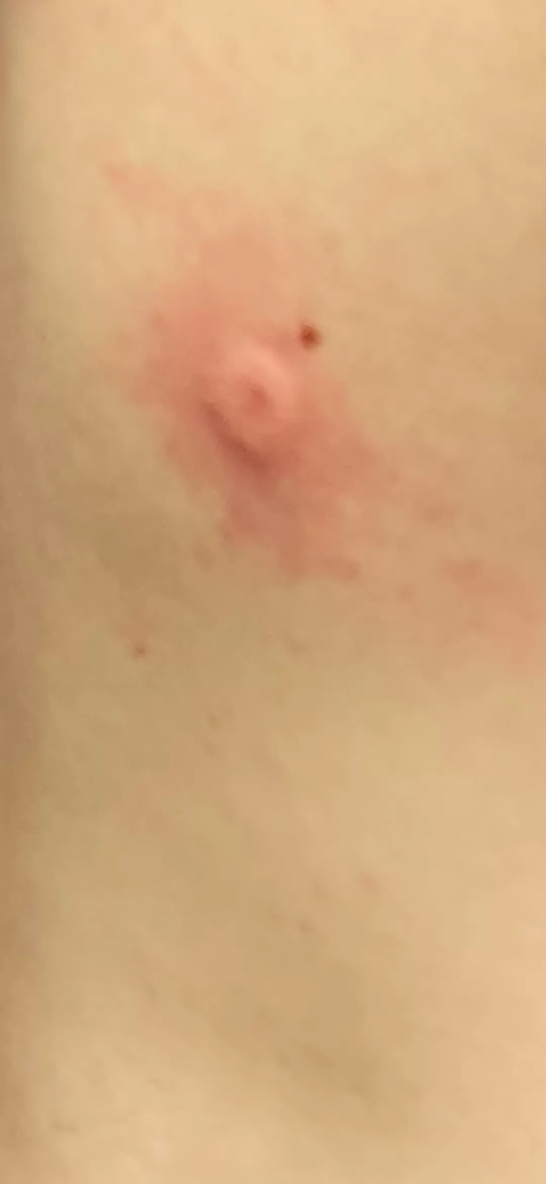 My friend shot my friend with a BB gun and grew an inverted nipple out of his back