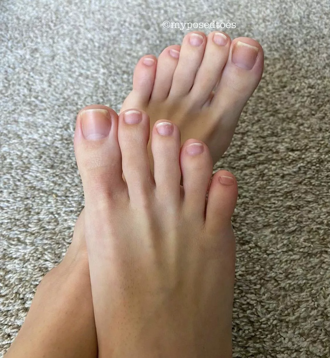 My natural toes are back!