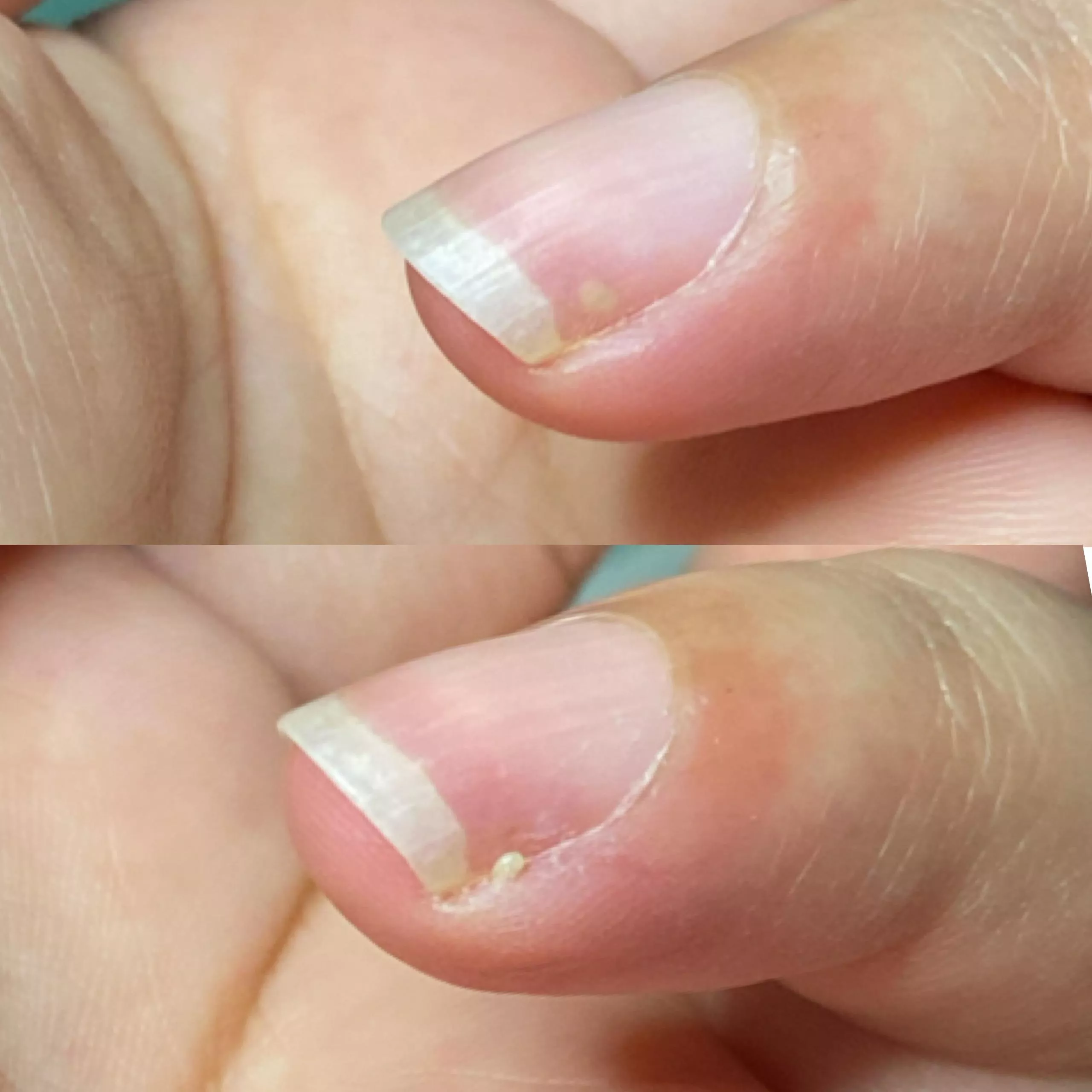 Omg - there was a pimple under my nail which i never thought would be a possibility.. i couldnt record it but took pictures