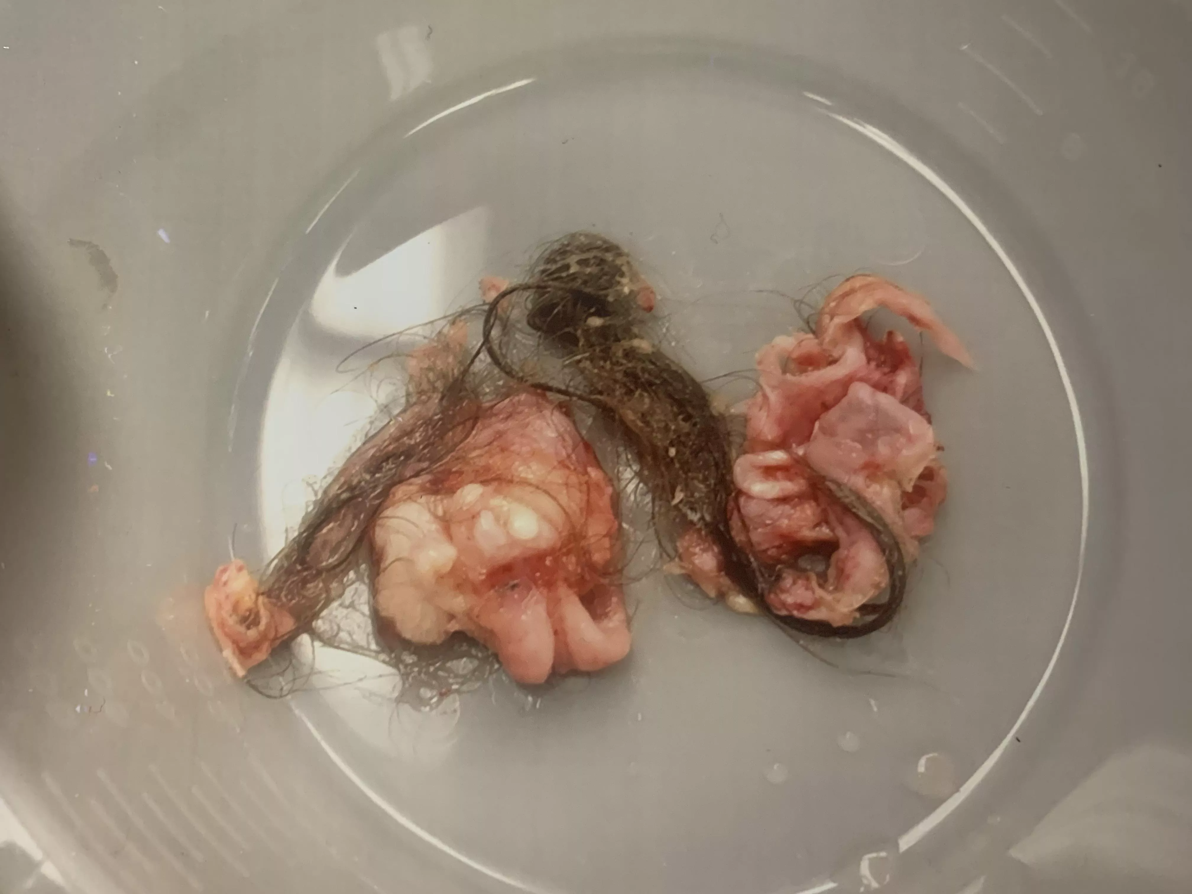 Ovarian Dermoid Cyst: complete with hair and even a tooth. 5cm