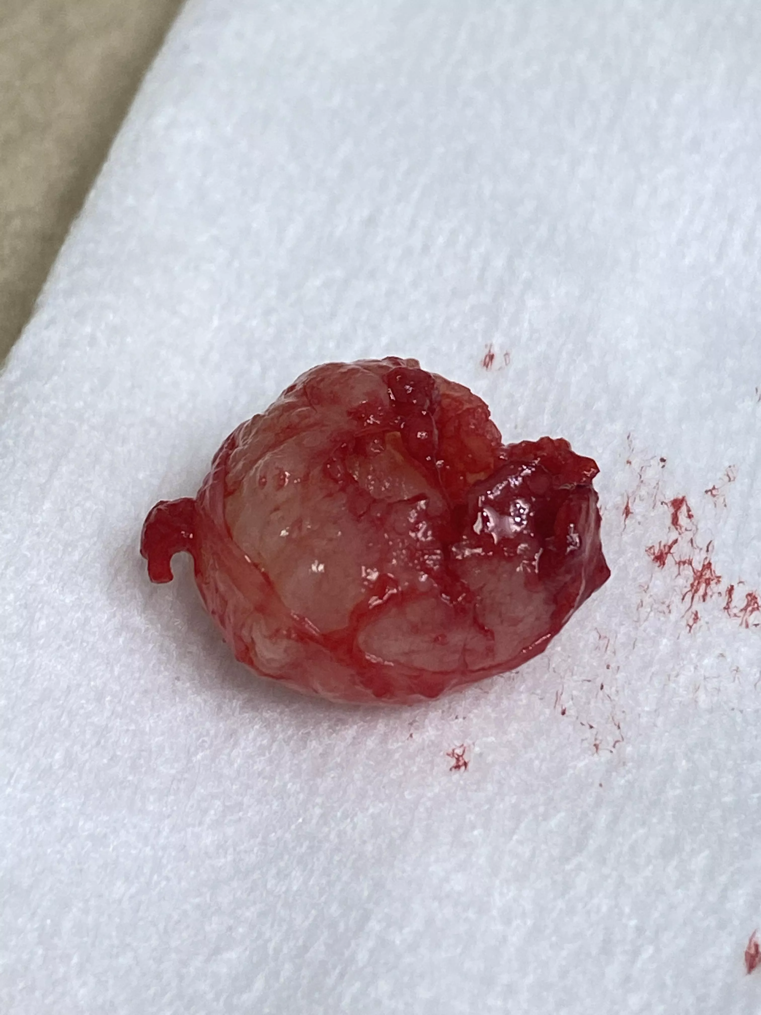 Pilar cyst removed from husband’s scalp today