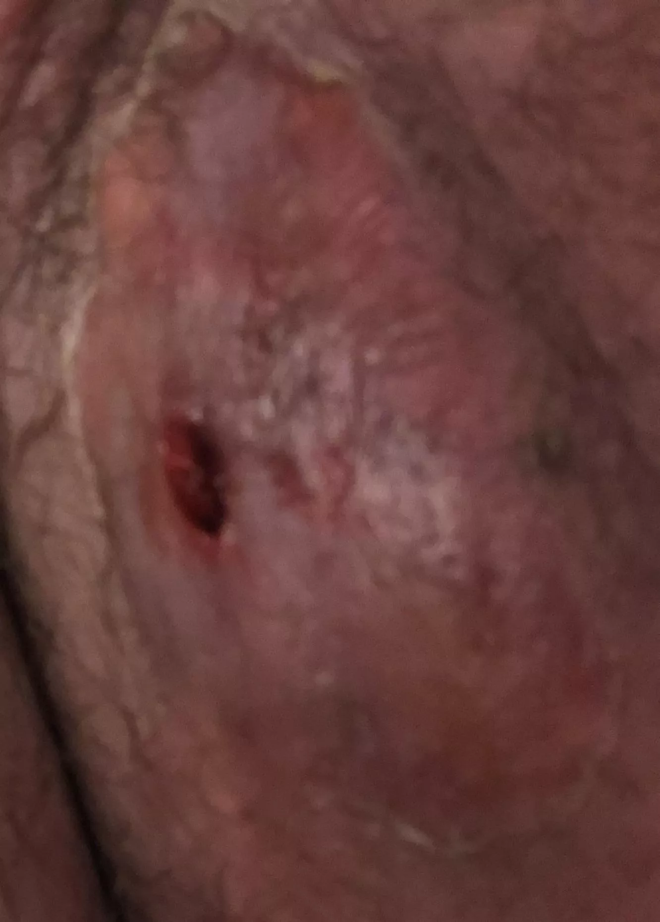 Possibly my final update. Unfortunately I never got to film it and all thatâ€™s left is a bloody hole. Now Iâ€™m just looking for ways to make sure it doesnâ€™t get infected while healing