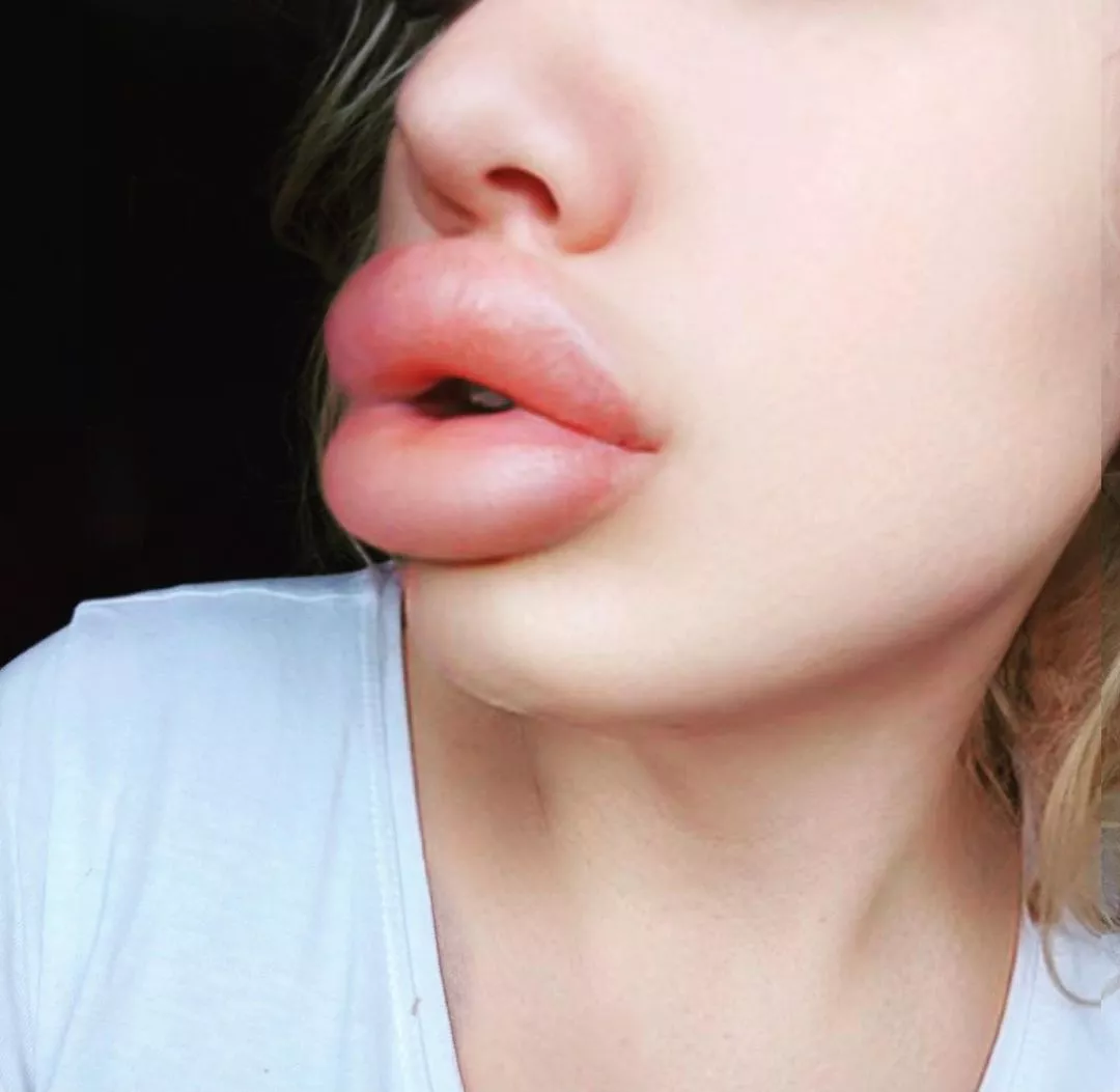 Post-filler, swollen lips are the best!