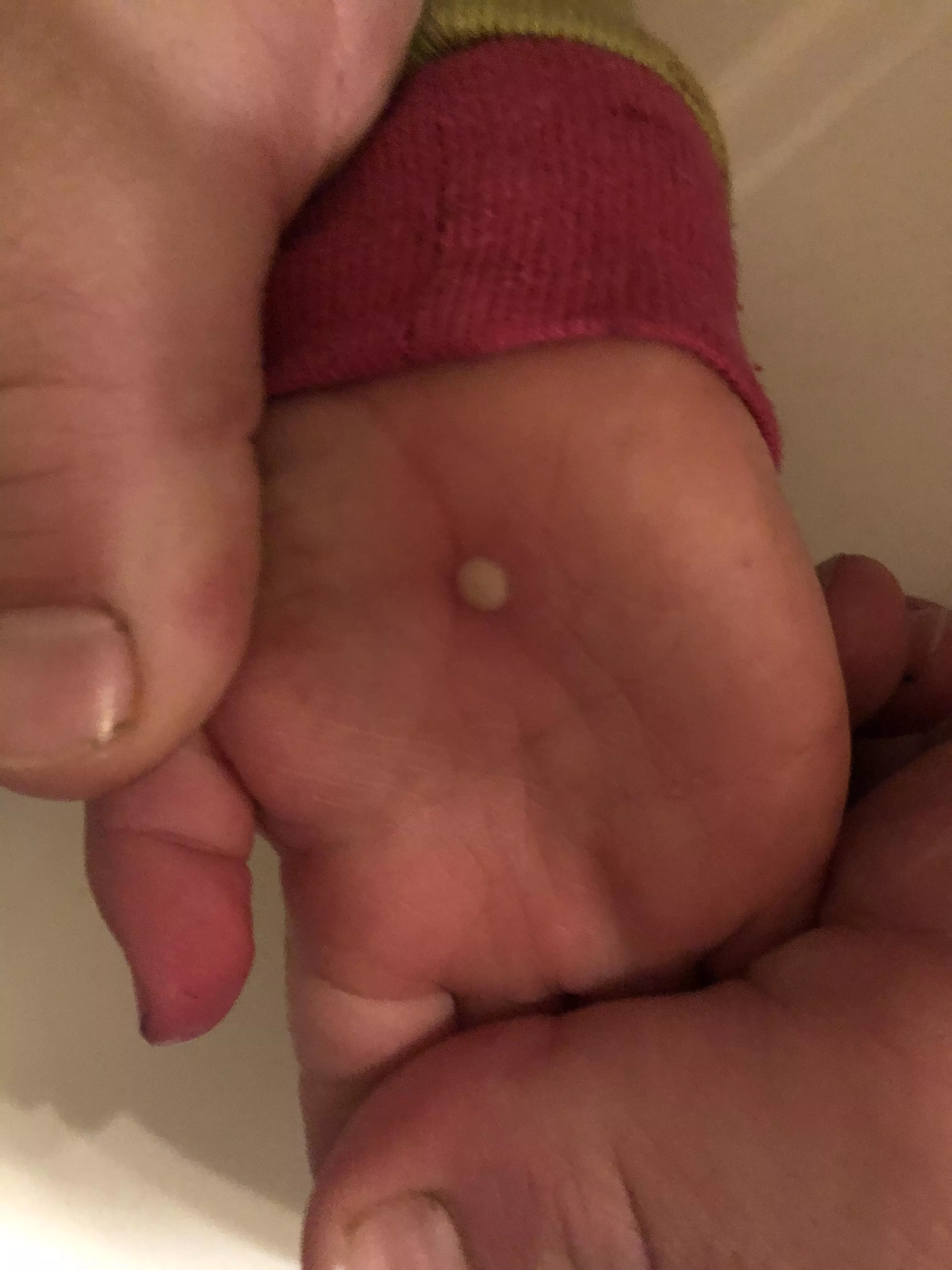 Random forbidden pop on 2 y/o daughterâ€™s hand. No idea where it came from and it just keeps getting bigger.