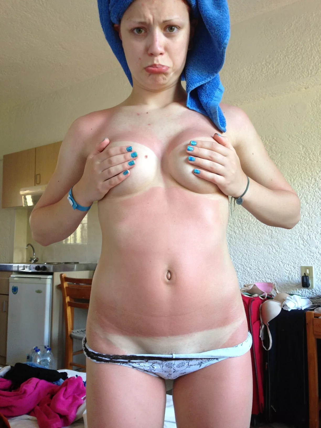 Sunburned Amateur