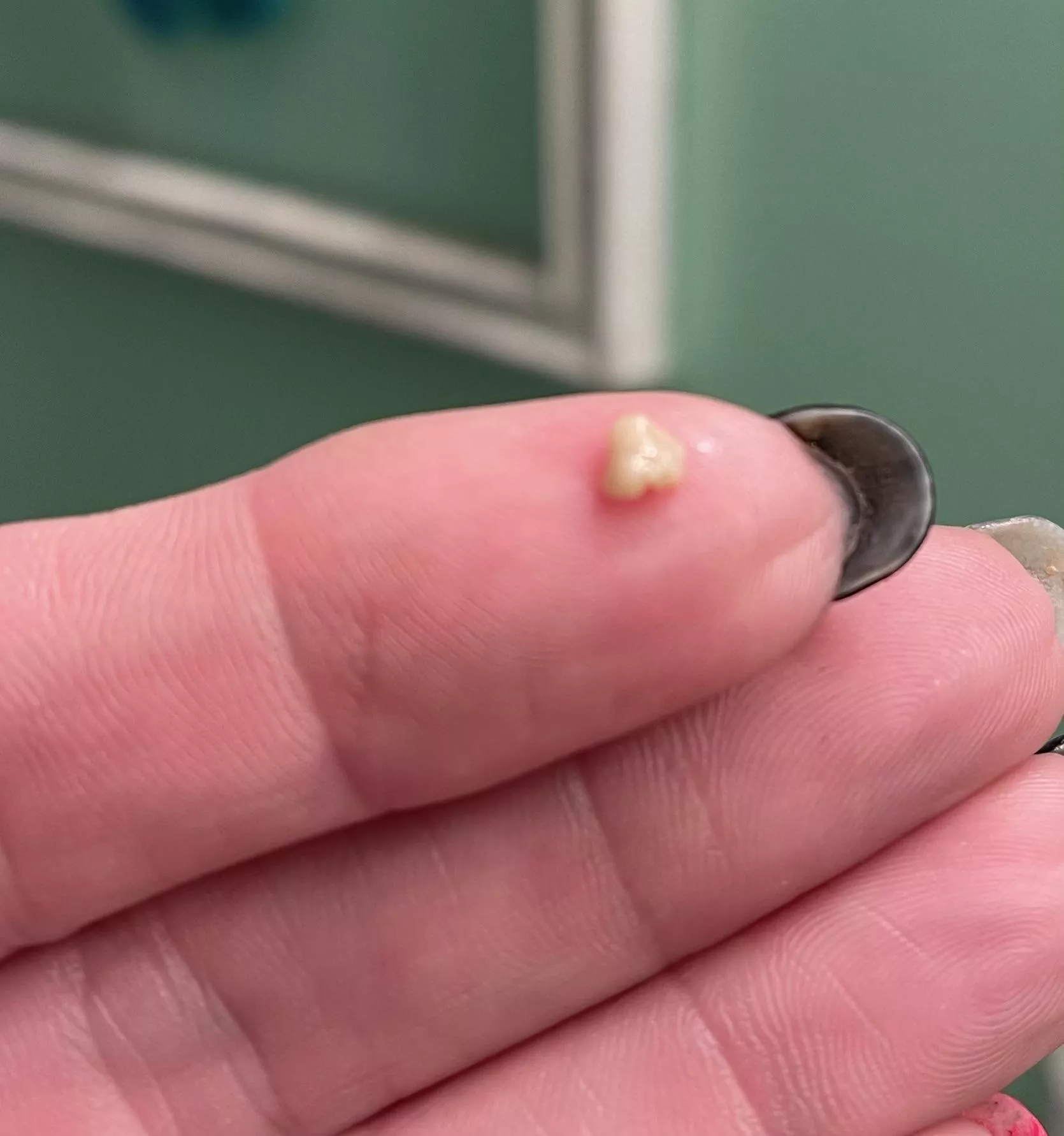 Surprise tonsil stone - only ever had one other before in my life.