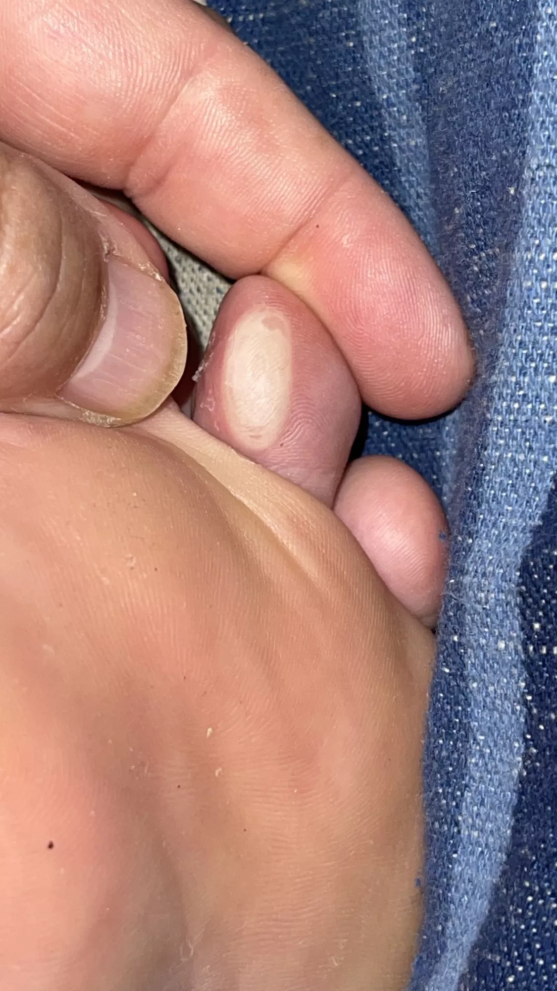 Thank you Disney World for this three day walking blister. iâ€™m surprised it never popped.