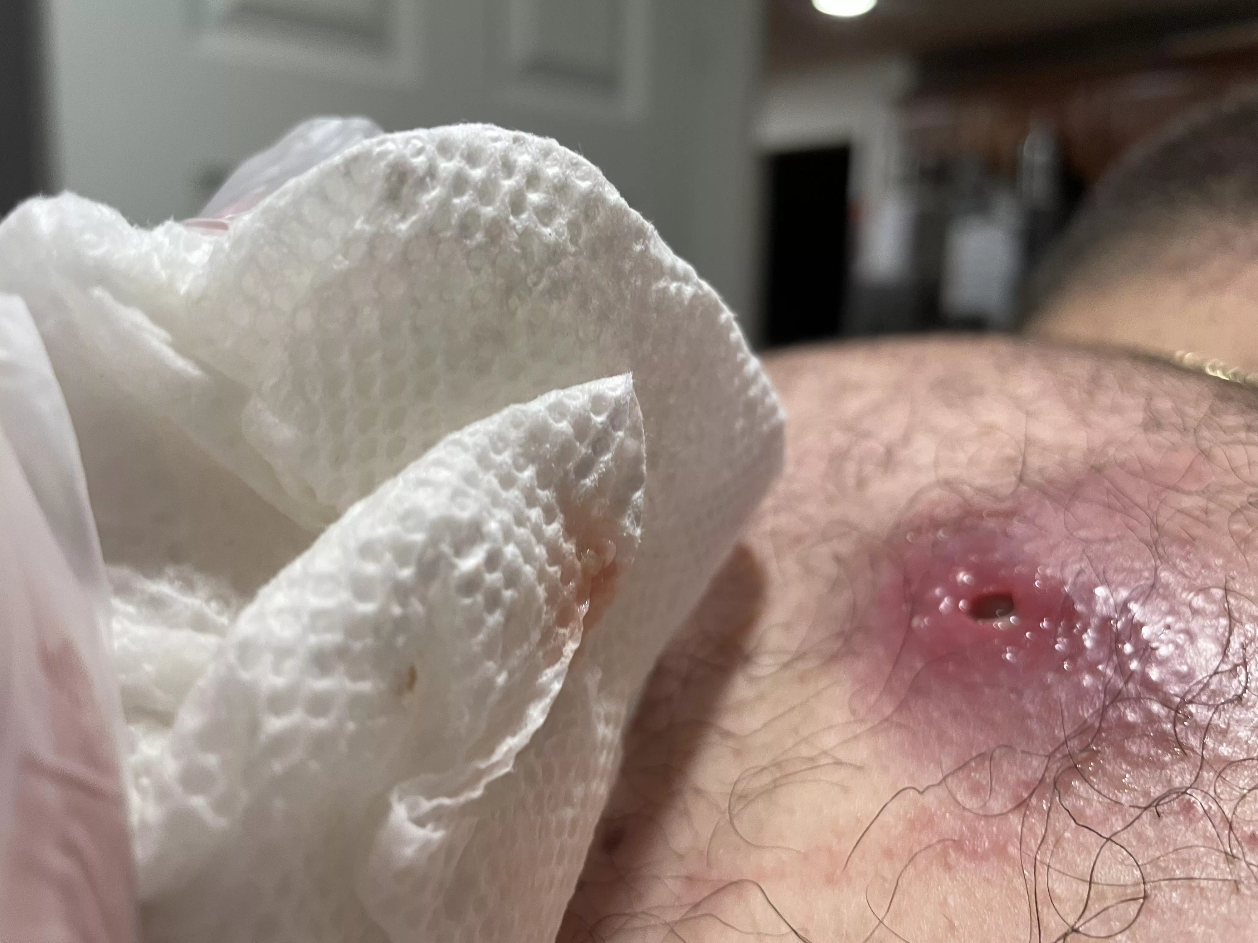 The aftermath of a cyst draining