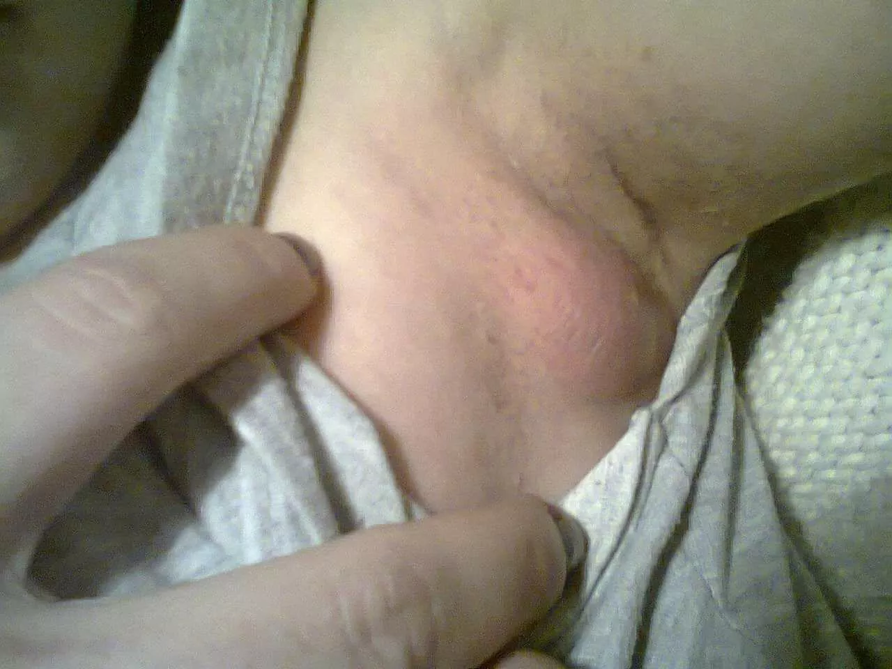 This is my armpit before surgery. Do you want to see how it looks now?