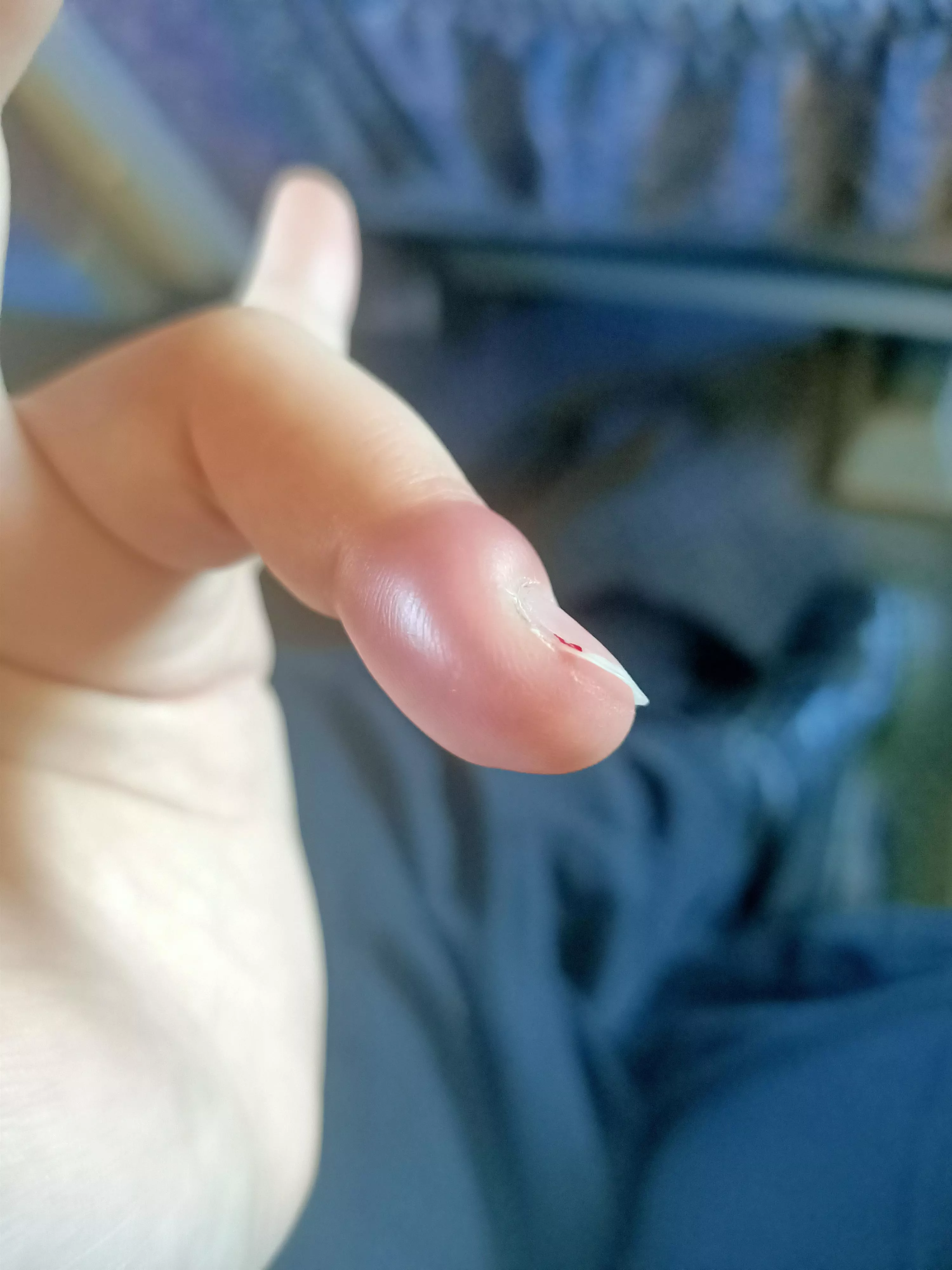 This weird thing on my finger. It's excruciating, and seems to be getting worse. Headed to the GP today, but figured you guys would find it interesting.