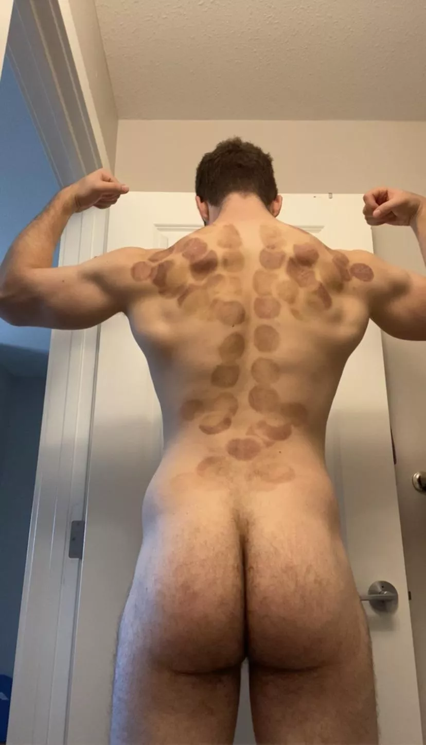 Tried cupping and I think my massage therapist went a little over board lol