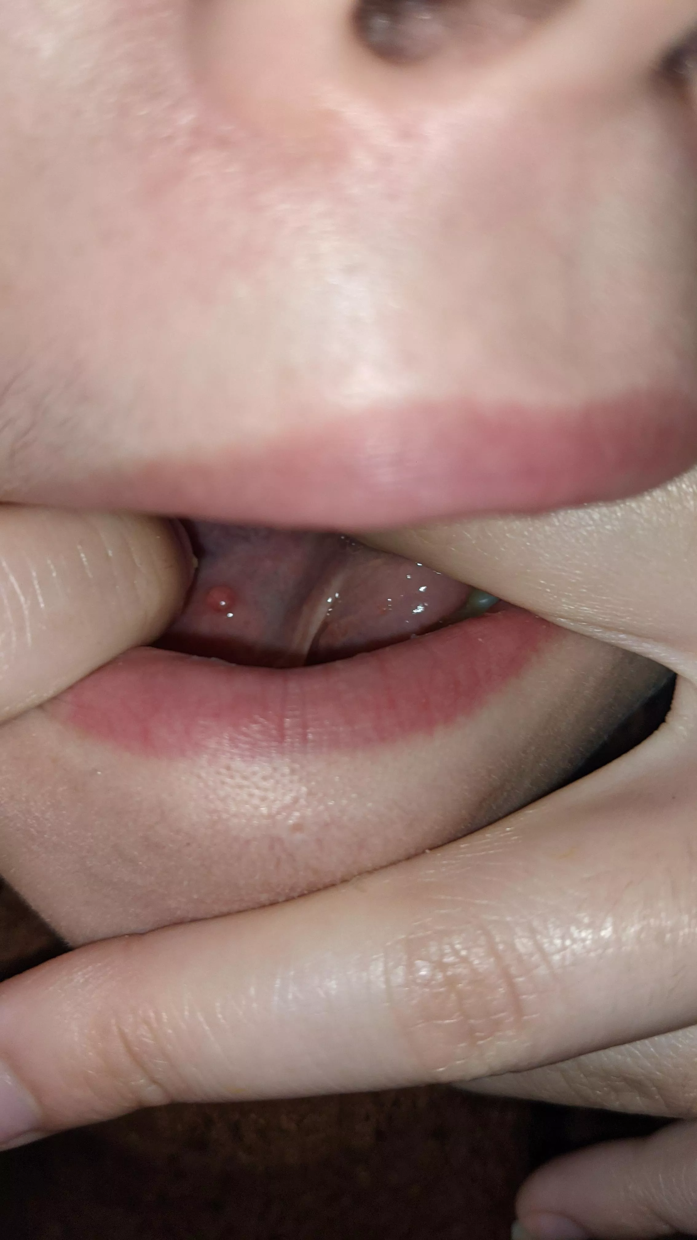 Weird lump under my tongue??? Does anyone know what it is?