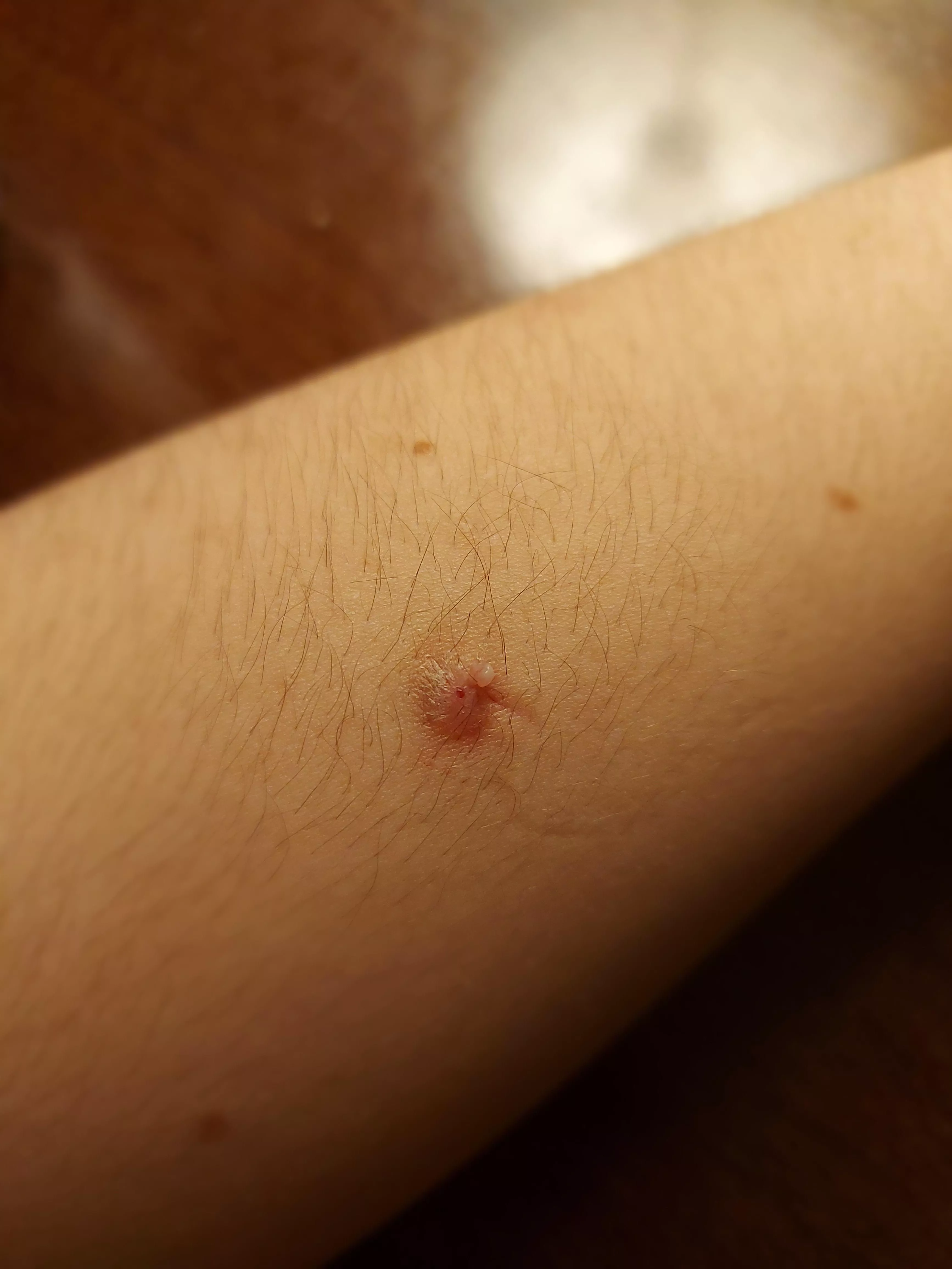 What is this on my arm? The skin around is rough, and it's the fifth time I've had to pop it. I have keratosis on my arms but have seen nothing like this before