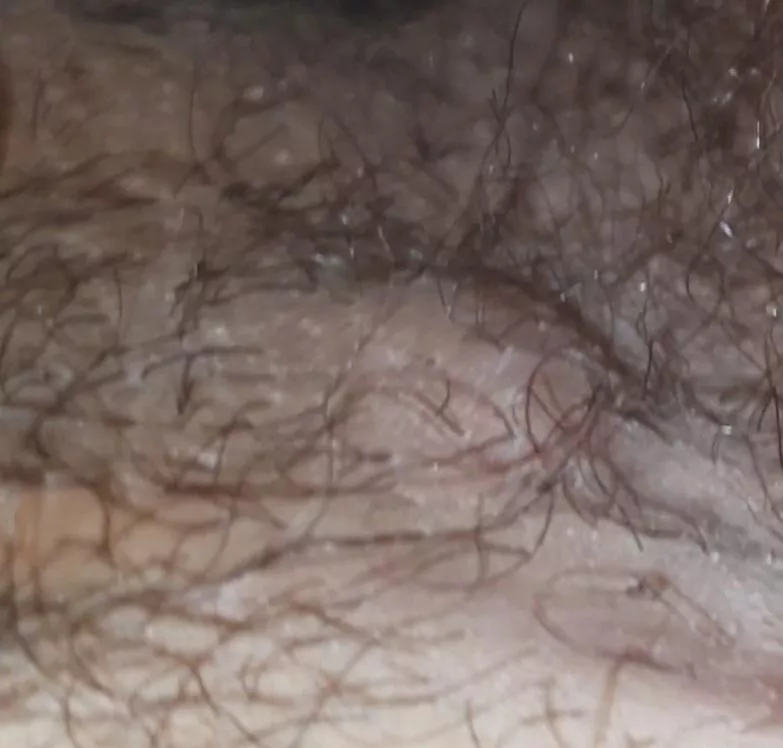 WHAT IS THIS(its near my pp and inner thigh)