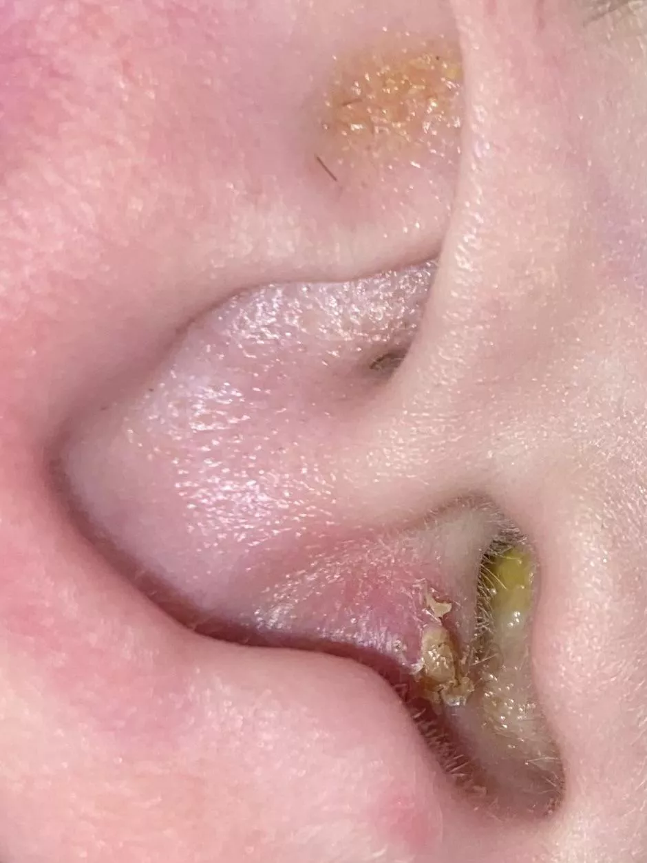 Where to start on my boyfriend’s ear…