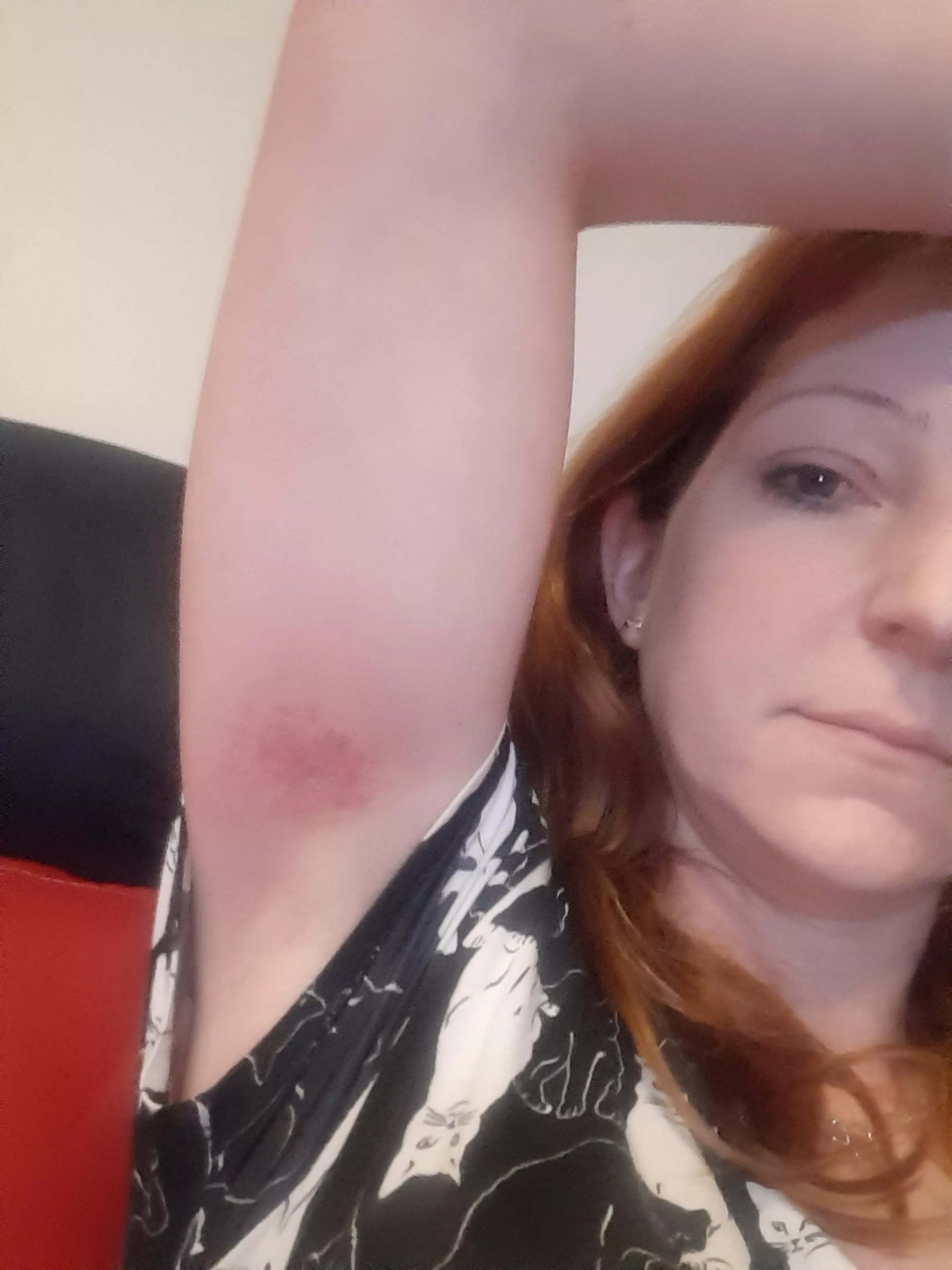 Yes, you can bruise an armpit